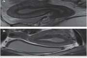 Diagnostic Value of Pelvic MRI for Assessment of the Depth of Myometrial Invasion and Cervical Involvement in Endometrial Cancer: Comparison of New Versus Old FIGO Staging 